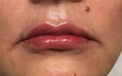Fillers Before & After Patient #13237