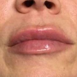 Fillers Before & After Patient #13234