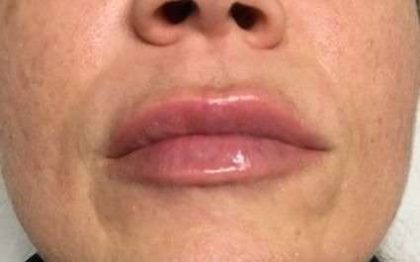 Fillers Before & After Patient #13234