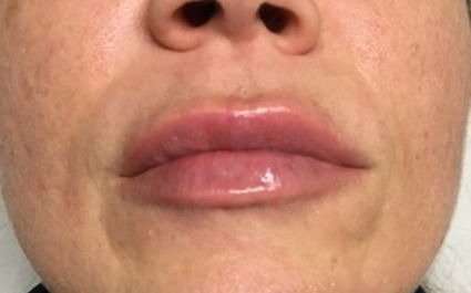 Fillers Before & After Patient #13234