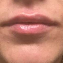 Fillers Before & After Patient #13231