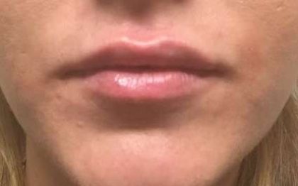 Fillers Before & After Patient #13231