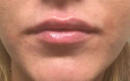 Fillers Before & After Patient #13231