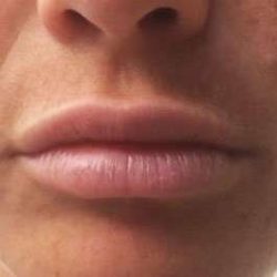 Fillers Before & After Patient #13228