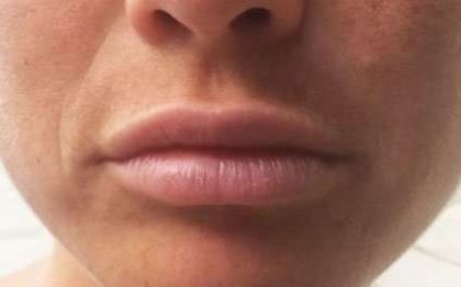 Fillers Before & After Patient #13228