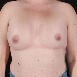 Breast Augmentation with Implants Before & After Patient #10870