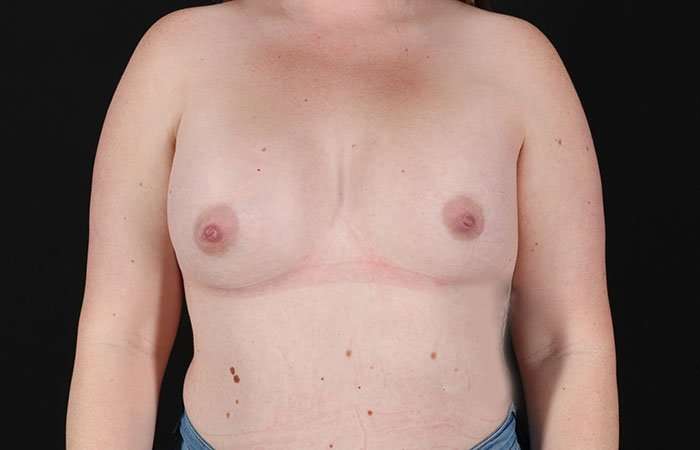 Breast Augmentation with Implants Before & After Patient #10870
