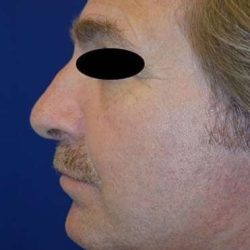 Chin Implant Before & After Patient #13670