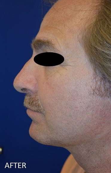Chin Implant Before & After Patient #13670