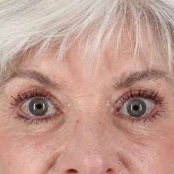 Blepharoplasty (Eyelid Surgery) Before & After Patient #13667