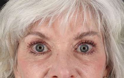 Blepharoplasty (Eyelid Surgery) Before & After Patient #13667