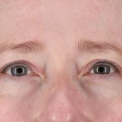 Blepharoplasty (Eyelid Surgery) Before & After Patient #13664