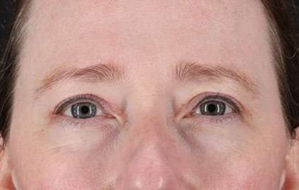 Blepharoplasty (Eyelid Surgery) Before & After Patient #13664