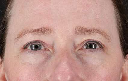 Blepharoplasty (Eyelid Surgery) Before & After Patient #13664