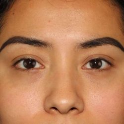 Blepharoplasty (Eyelid Surgery) Before & After Patient #13661