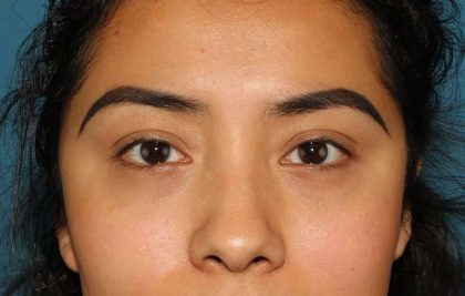 Blepharoplasty (Eyelid Surgery) Before & After Patient #13661