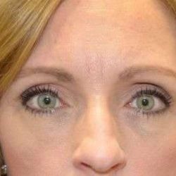 Blepharoplasty (Eyelid Surgery) Before & After Patient #13658
