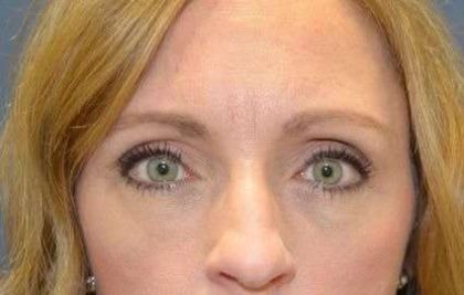 Blepharoplasty (Eyelid Surgery) Before & After Patient #13658