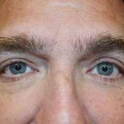 Blepharoplasty (Eyelid Surgery) Before & After Patient #13655