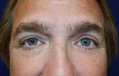 Blepharoplasty (Eyelid Surgery) Before & After Patient #13655