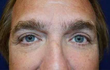 Blepharoplasty (Eyelid Surgery) Before & After Patient #13655