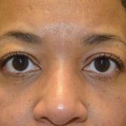 Blepharoplasty (Eyelid Surgery) Before & After Patient #13652