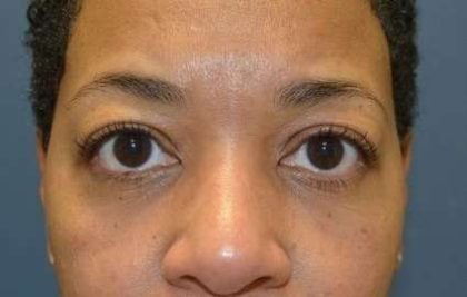 Blepharoplasty (Eyelid Surgery) Before & After Patient #13652