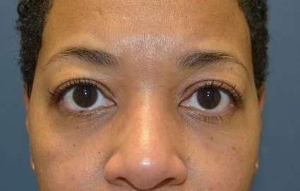 Blepharoplasty (Eyelid Surgery) Before & After Patient #13652