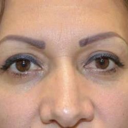 Blepharoplasty (Eyelid Surgery) Before & After Patient #13649