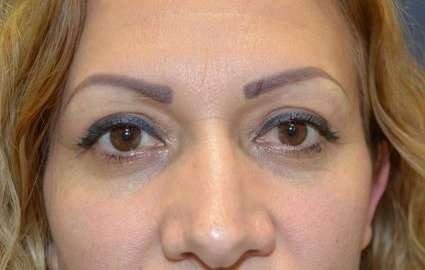 Blepharoplasty (Eyelid Surgery) Before & After Patient #13649