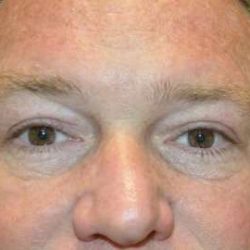 Blepharoplasty (Eyelid Surgery) Before & After Patient #13646
