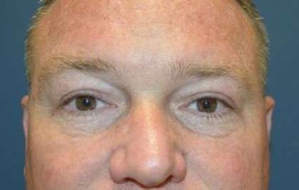 Blepharoplasty (Eyelid Surgery) Before & After Patient #13646