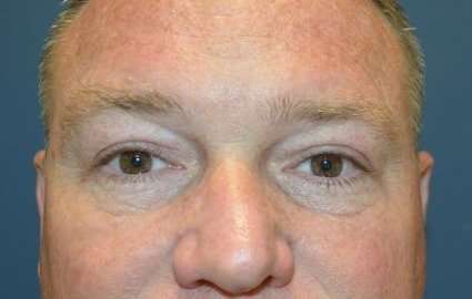 Blepharoplasty (Eyelid Surgery) Before & After Patient #13646
