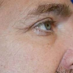 Blepharoplasty (Eyelid Surgery) Before & After Patient #13643