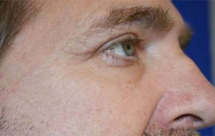 Blepharoplasty (Eyelid Surgery) Before & After Patient #13643