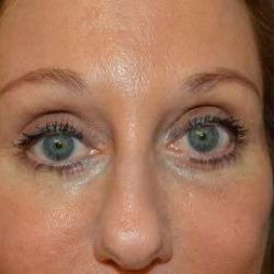 Blepharoplasty (Eyelid Surgery) Before & After Patient #13640