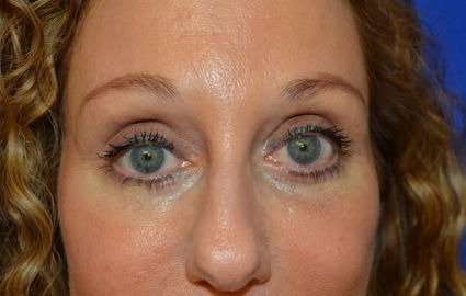 Blepharoplasty (Eyelid Surgery) Before & After Patient #13640