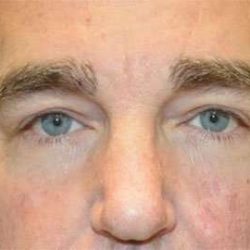 Blepharoplasty (Eyelid Surgery) Before & After Patient #13637
