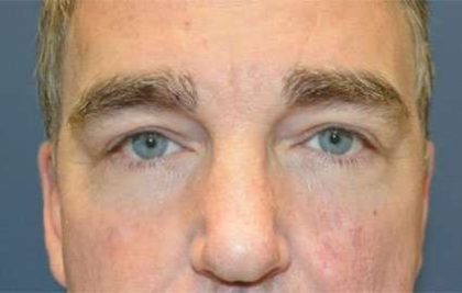Blepharoplasty (Eyelid Surgery) Before & After Patient #13637