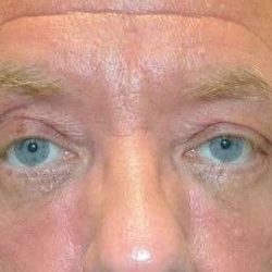 Blepharoplasty (Eyelid Surgery) Before & After Patient #13634
