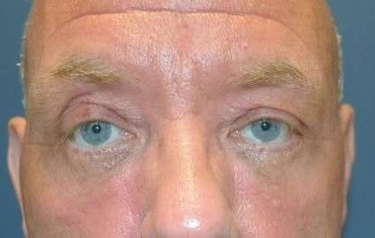Blepharoplasty (Eyelid Surgery) Before & After Patient #13634