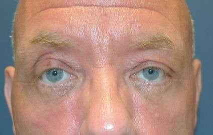 Blepharoplasty (Eyelid Surgery) Before & After Patient #13634