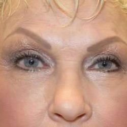 Blepharoplasty (Eyelid Surgery) Before & After Patient #13631
