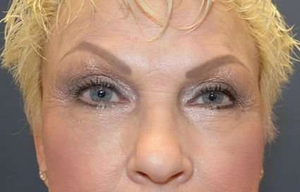 Blepharoplasty (Eyelid Surgery) Before & After Patient #13631