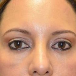 Blepharoplasty (Eyelid Surgery) Before & After Patient #13628