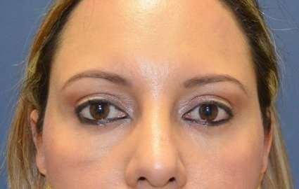 Blepharoplasty (Eyelid Surgery) Before & After Patient #13628