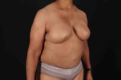 Breast Reconstruction Before & After Patient #10914