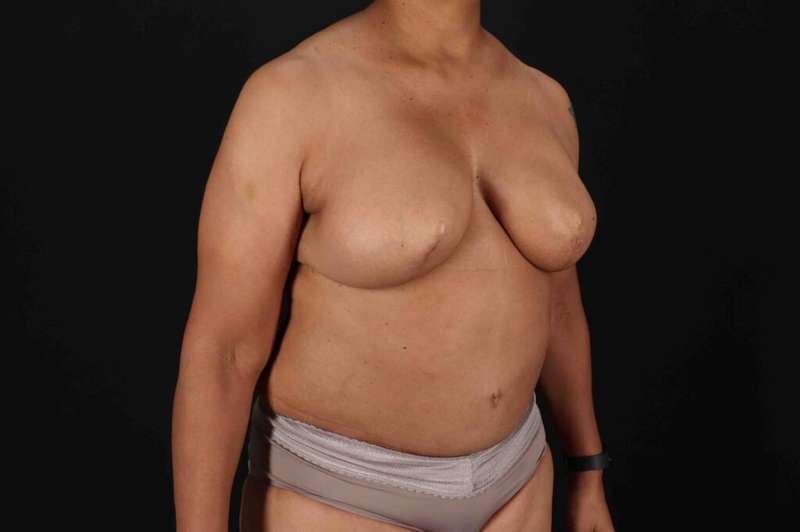 Breast Reconstruction Before & After Patient #10914