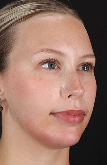 Fillers Before & After Patient #13309