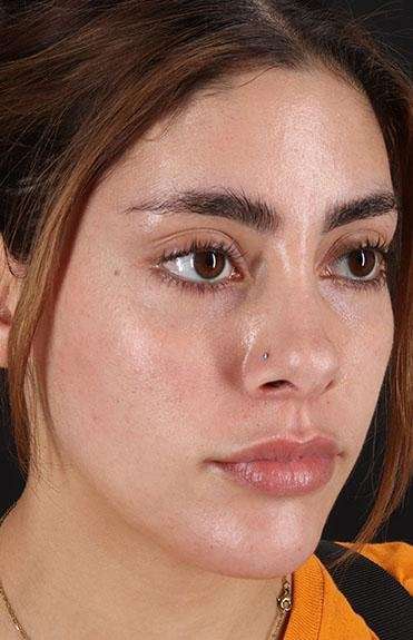 Fillers Before & After Patient #13287